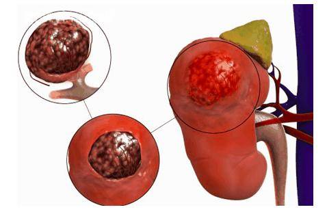 腹腔镜保留肾单位的肾肿瘤切除术
