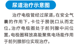 前列腺场效治疗