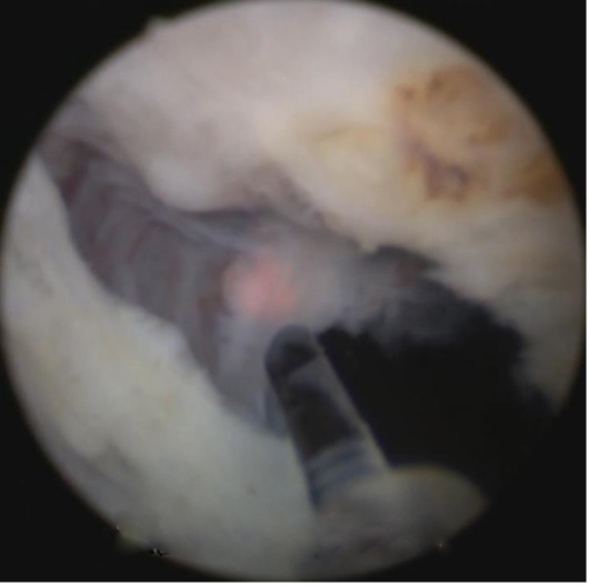 经尿道前列腺剜除术