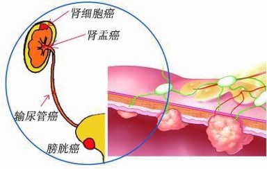 腹腔镜肾输尿管尿路上皮癌根治性切除术